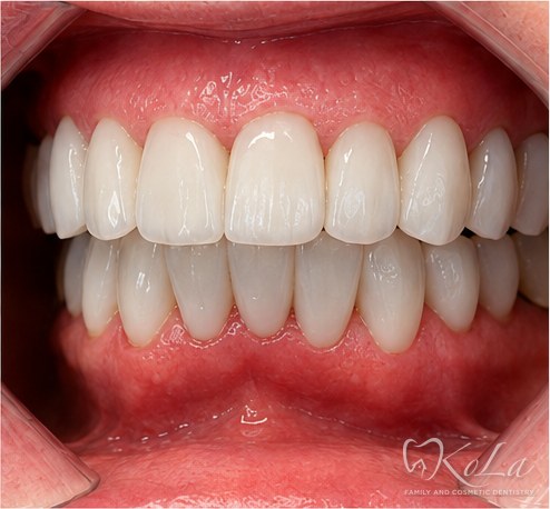 Even bright teeth after Invisalign, porcelain veneers and crowns smile makeover